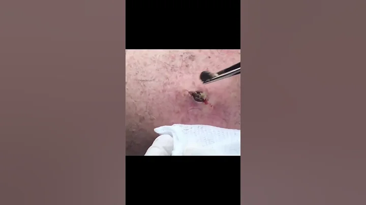 Blackhead New Years Pop!