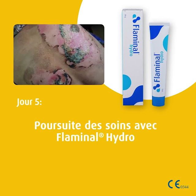 Étude de cas Flaminal® pour le traitement d