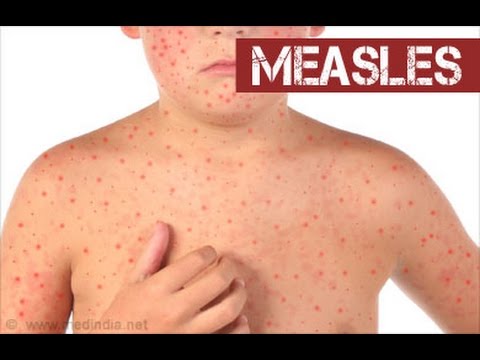 Measles (Rubeola) 