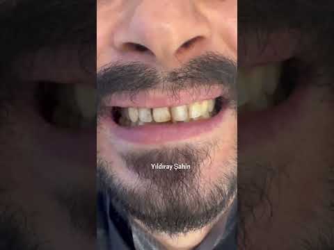 TEK SEANSTA KOMPOZİT