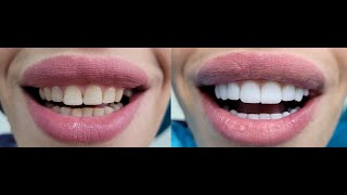 3D Veneers with natural-looking layers