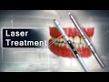 Dental medical animation  benefits of laser treatment than traditional treatment
