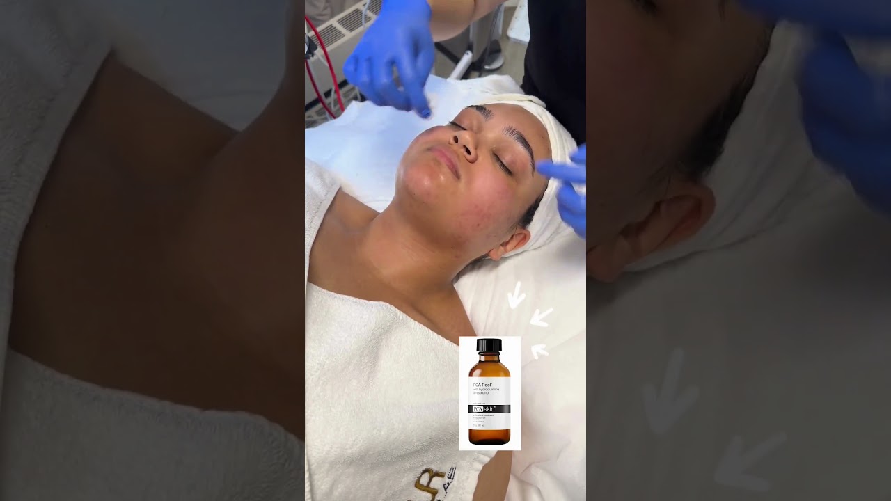 Acne Control Treatment with PCA Skin Jessner Peel