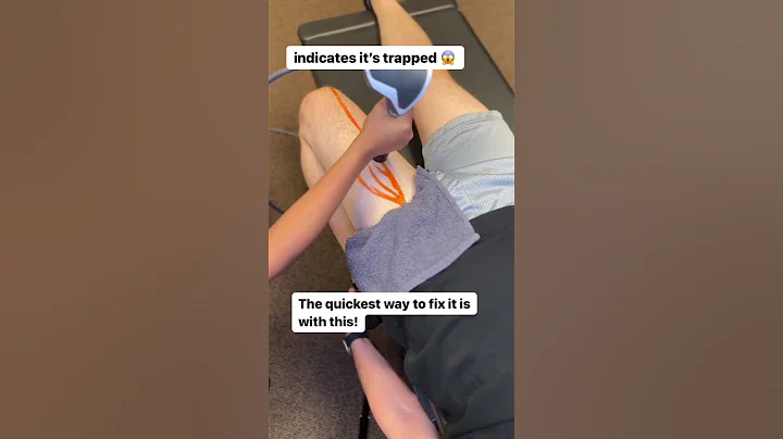 What Happens When Your Femoral Nerve Gets Stuck?