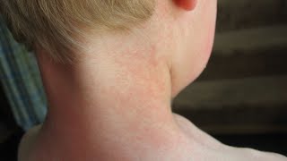 Scarlet Fever Treatment at Home screenshot 1