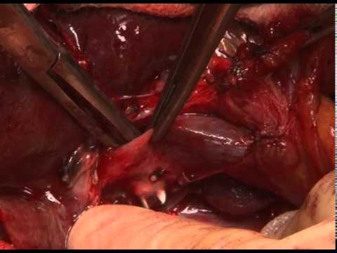 Right Hemihepatectomy:The Leeds HPB and Transplant Centre