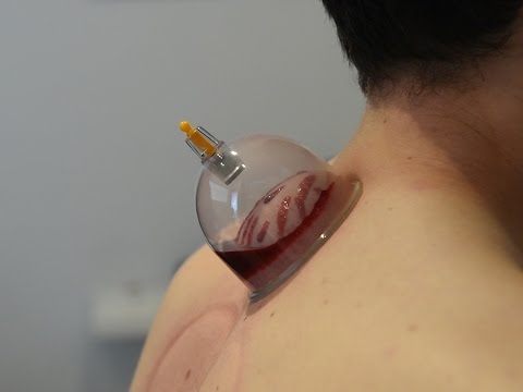 Video: What is hijama and what is it for