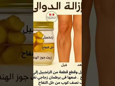 علاج دوالي الساقين جنزبيل خل تفاح زيت جوزه الهند اكسبلور وصفات طبيعية نباتي ترند