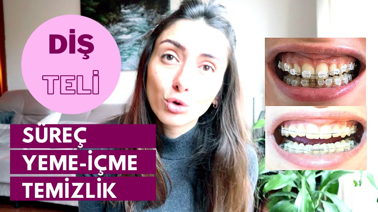 DİŞ TELİMİ NASIL TAKTIRDIM? NELER YAŞIYORUM?