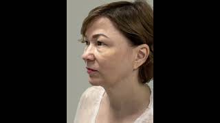 Верхняя и нижняя трансконъюнктивальная блефаропластика, подтяжка кожи лица и шеи с перемещением СМАС
