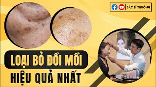 Cách trị đồi mồi đốm nâu ở mặt, tay | Bác sĩ Trường