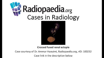 Crossed fused renal ectopia (Radiopaedia.org) Cases in Radiology