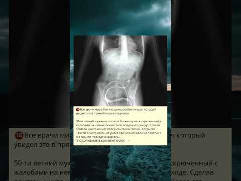 Videó: Röntgenen megjelenne gerincdaganat?