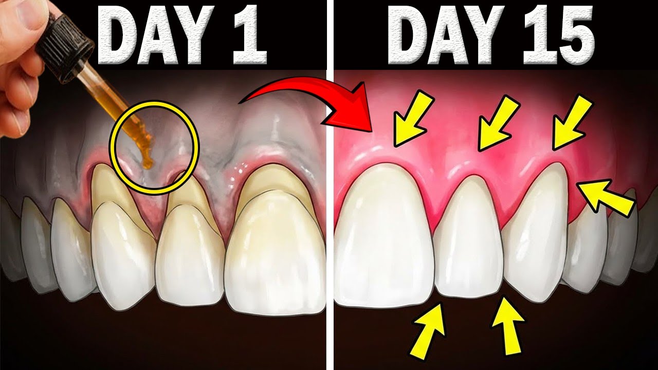 Reverse Receding Gums with This 3-Oil Mixture 💥 (Dentists HATE This)