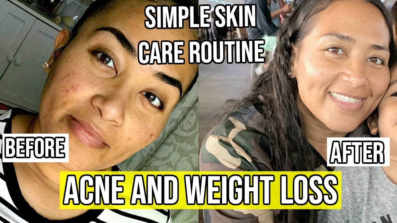 HOW WEIGHT LOSS HELPED MY ACNE / SIMPLE SKIN CARE ROUTINE FOR ACNE