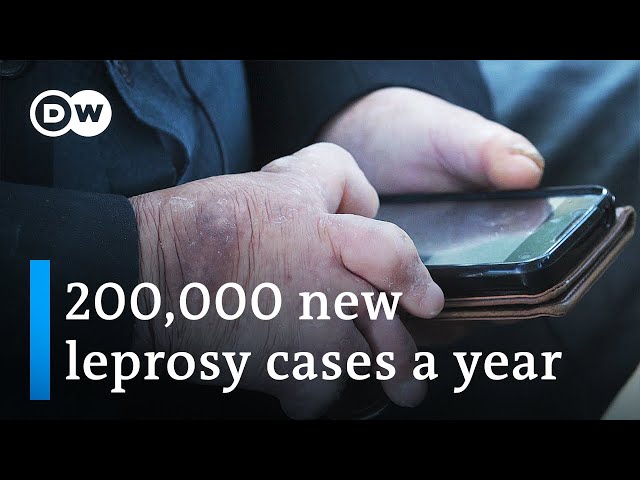 Why leprosy still disables millions of people worldwide | DW News