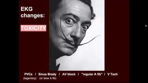 Digoxin EKG changes:  "EM in 5"