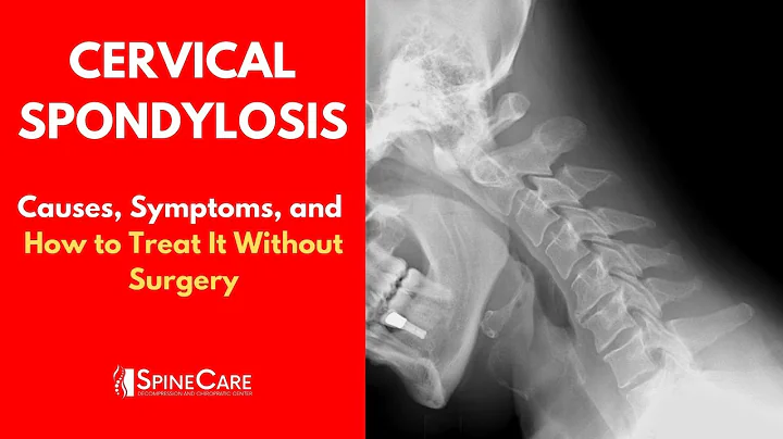 CERVICAL SPONDYLOSIS Causes, Symptoms and Treatment (NO SURGERY) - DayDayNews