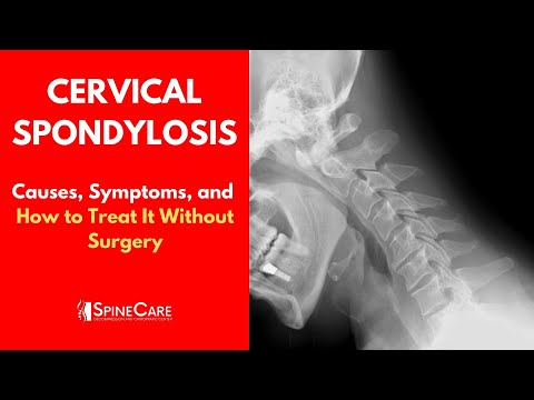 Video: Osteochondrosis Of The Cervicothoracic Spine: Symptoms, Treatment