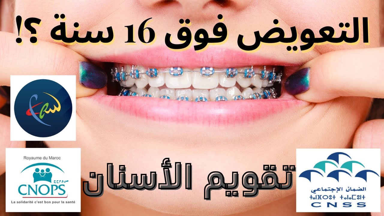 CNSS CNOPS كل ما يخص تعويضات تقويم الأسنان  🦷