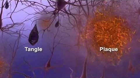 Inside the Brain: Unraveling the Mystery of Alzheimer