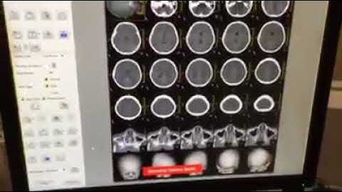 Scanning skull of Philips CT is very good image and fast scanning