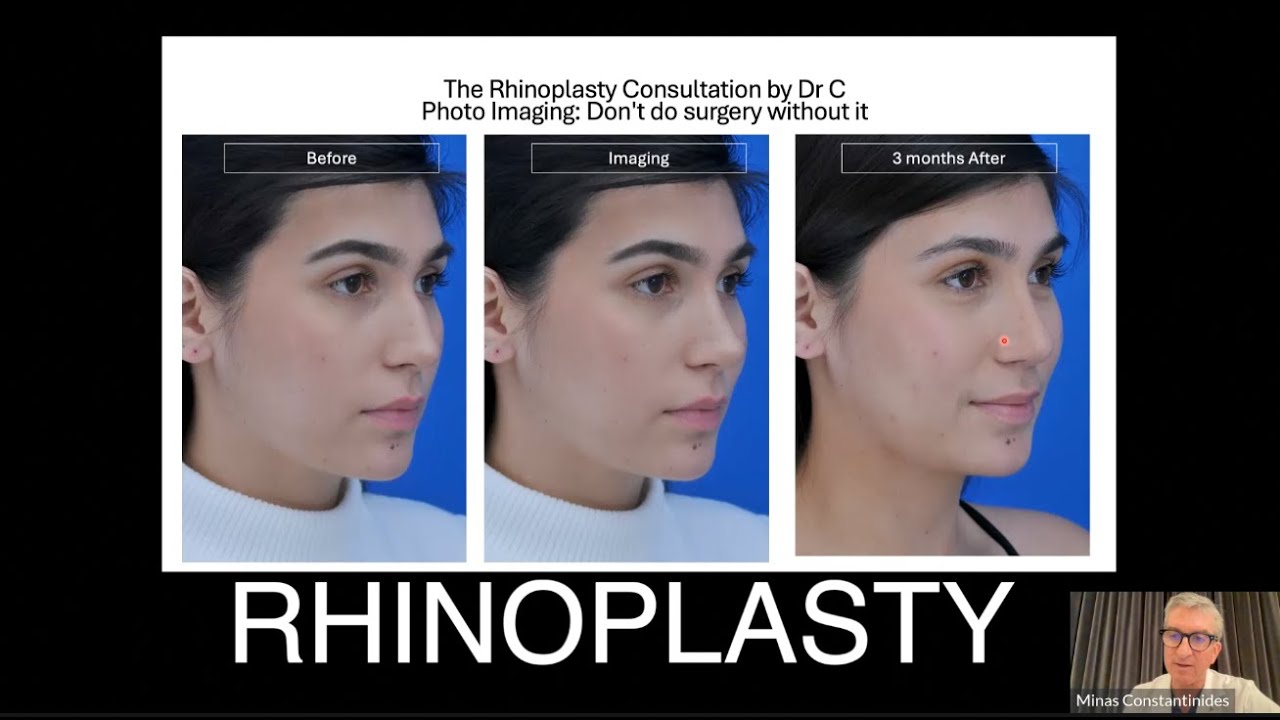 RHINOPLASTY WEBINAR WITH DR. CONSTANTINIDES 