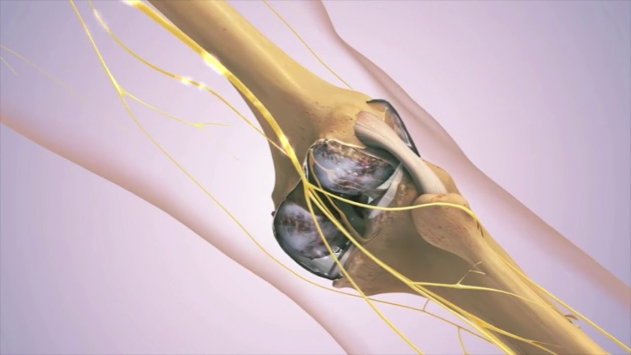 Ohio doctor provides Hyaluronic Acid Knee injections YouTube