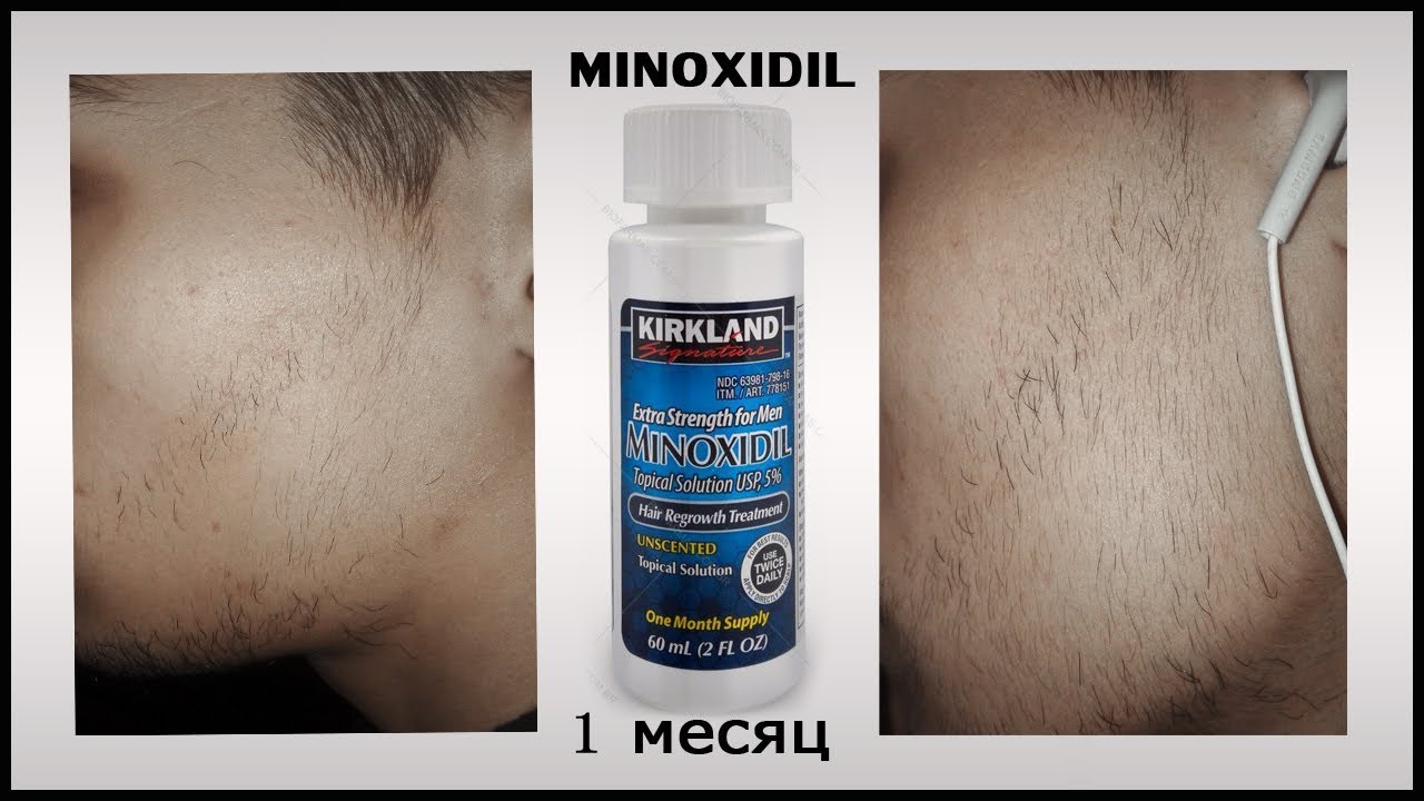 Миноксидил форум. Миноксидил 3 в 1. Миноксидил эффект 6 мес. Миноксидил алерана эффект.