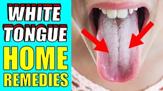 What Causes White Tongue | HOW TO GET RID OF WHITE TONGUE QUICKLY