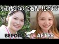 【A CLINIC×もえちょびん】気になる美容施術をリアルレビュー
