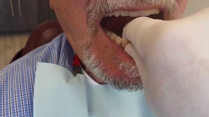 Lower Suction Dentures (SEMCD) from Ottawa South Denture Clinic