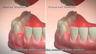 Socket Preservation by Bioscaffold 4,770 views 14 years ago 2 minutes, 33 seconds