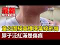 童公園騎車遭風箏線割傷 脖子泛紅滿是傷痕【最新快訊】