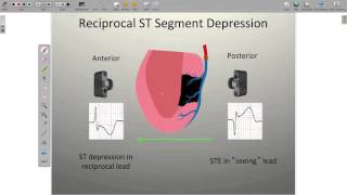 Localizing Ischemia on the ECG