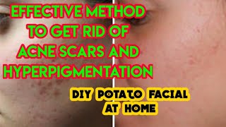 How to remove acne scars and hyperpigmentation naturally at home. Diy potato facial for pimples