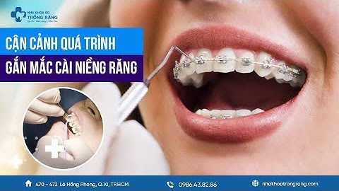 Gắn mắc cài niềng răng có đau không?