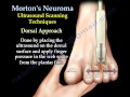 Morton's Neuroma - Everything You Need To Know - Dr. Nabil Ebraheim