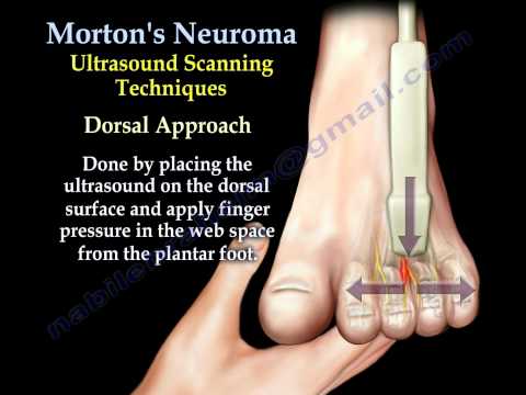 Morton&rsquo;s Neuroma - Everything You Need To Know - Dr. Nabil Ebraheim