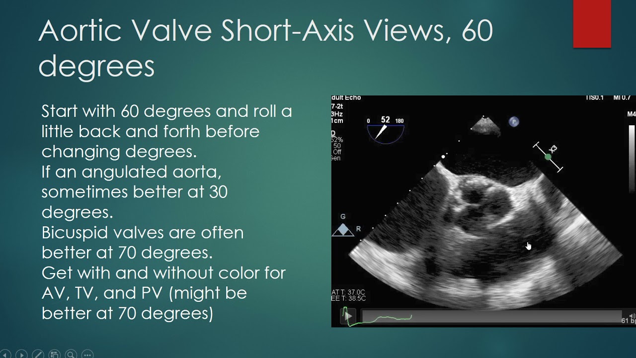 Transesophageal Echocardiogram (TEE) Basics 5- How to acquire good images.