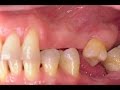 As Consequências de Perder um Dente - Efeito Dominó da Perda Dentária