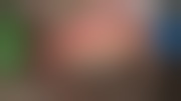 Phaco iStent Goniosynechialysis and Goniotomy in Angle Closure Glaucoma