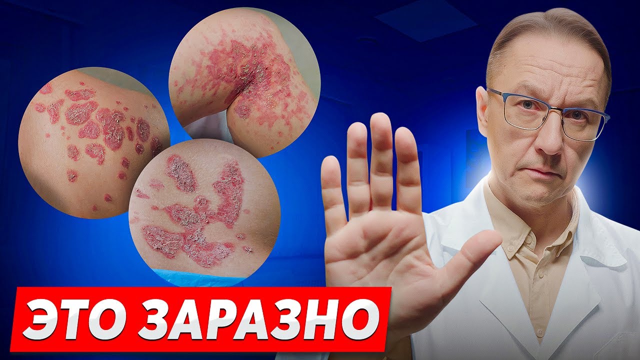 8 самых опасных мифов о ПСОРИАЗЕ: что происходит с кожей НА САМОМ ДЕЛЕ
