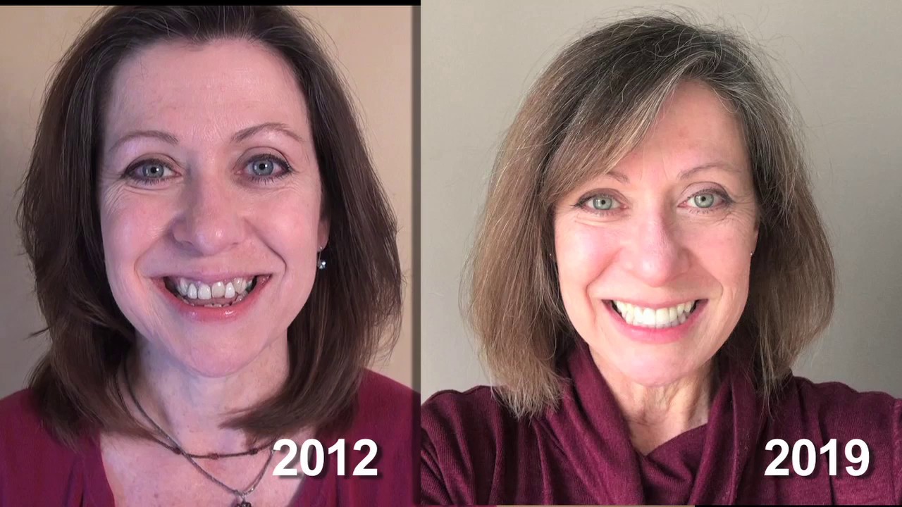 Before, during and after jaw surgery - Open, under, and cross bite