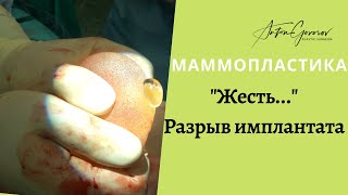 Жесть! Разрыв имплантата молочной железы. Что делать?