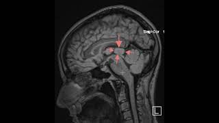 Pineal cyst