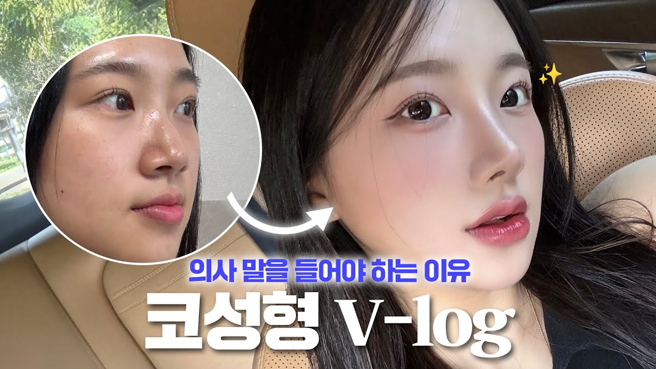 코 성형은 의사 말을 들어야 하는 이유 feat.콧볼축소 l 코성형후기
