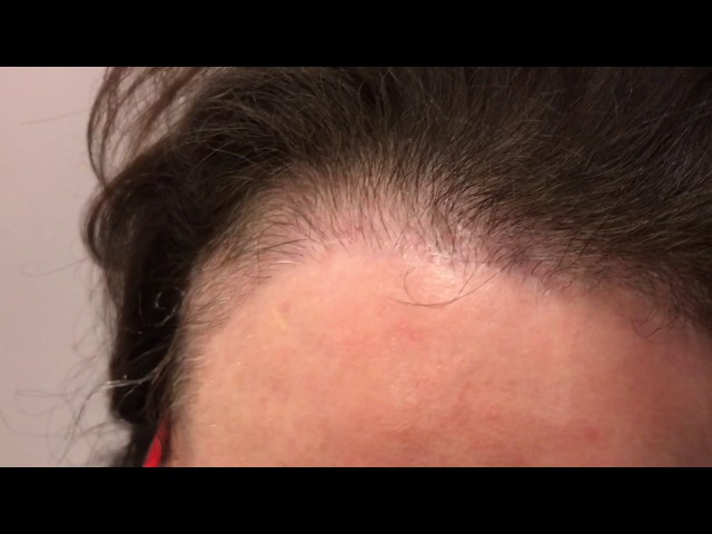 Dallas Female Hairline Lowering Hair Transplant HD Early Result