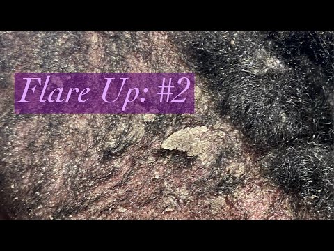 Flare Up: Part 2