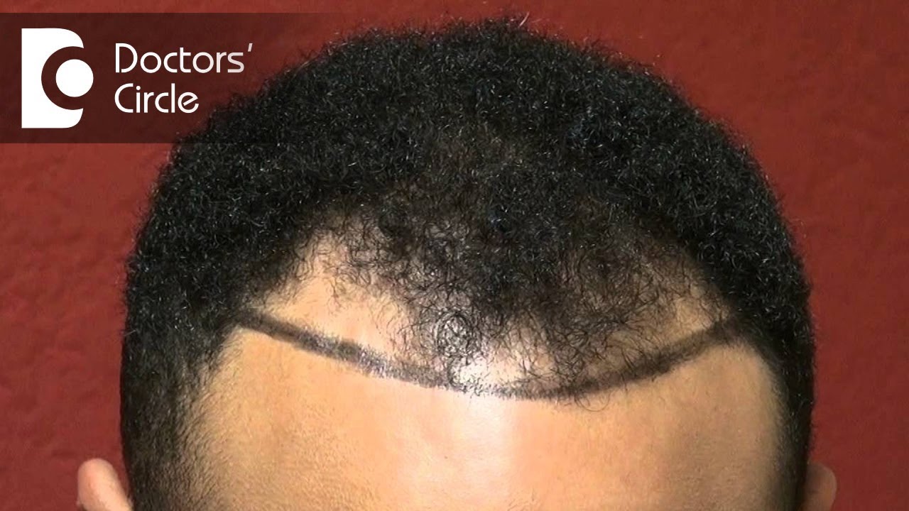 Treatment options to control hair fall leading to receding frontal hairline - Dr. Aruna Prasad